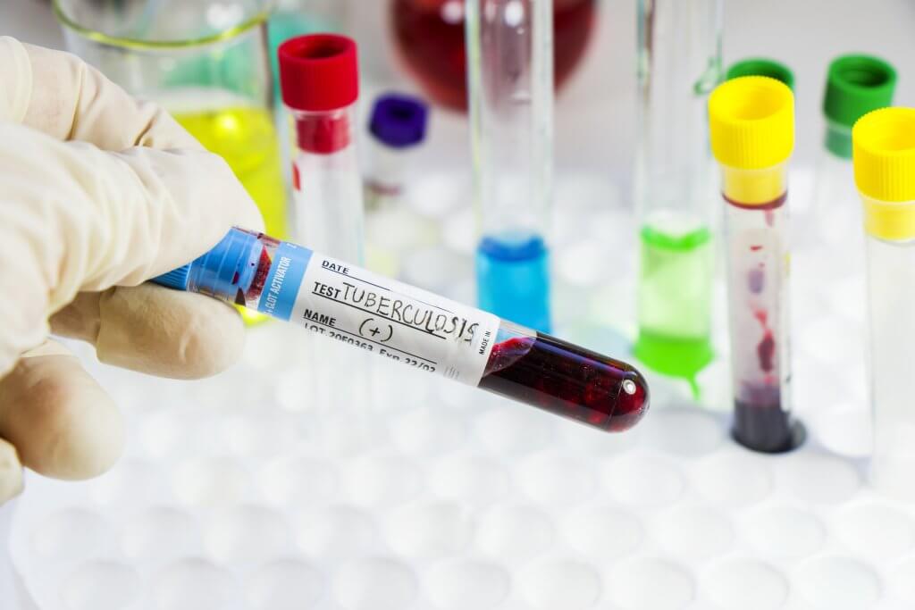 Closeup shot of a tube for a tuberculosis test in the laboratory