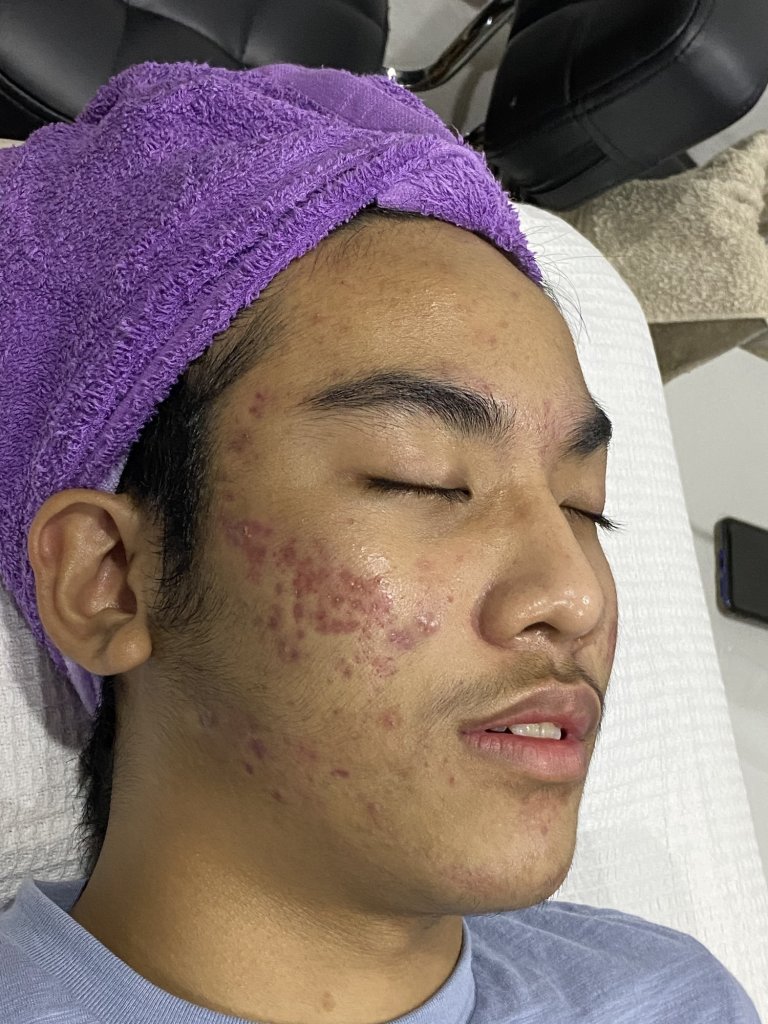 Acne problems