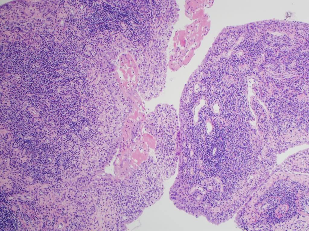 Rheumatoid disease-H&E stain, light microscopy, rheumatoid arthritis of joint showing inflammation and hyperplasia