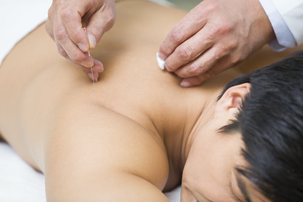 hormonal balance-Patient receiving acupuncture