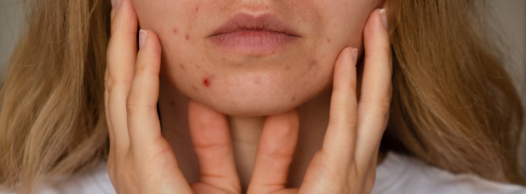 Acne-Prone Skin